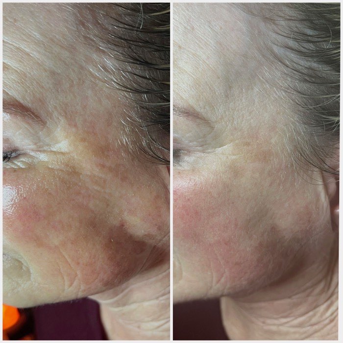 Before and after a course of treatment at Envy Skin Studio, example 1 of 16