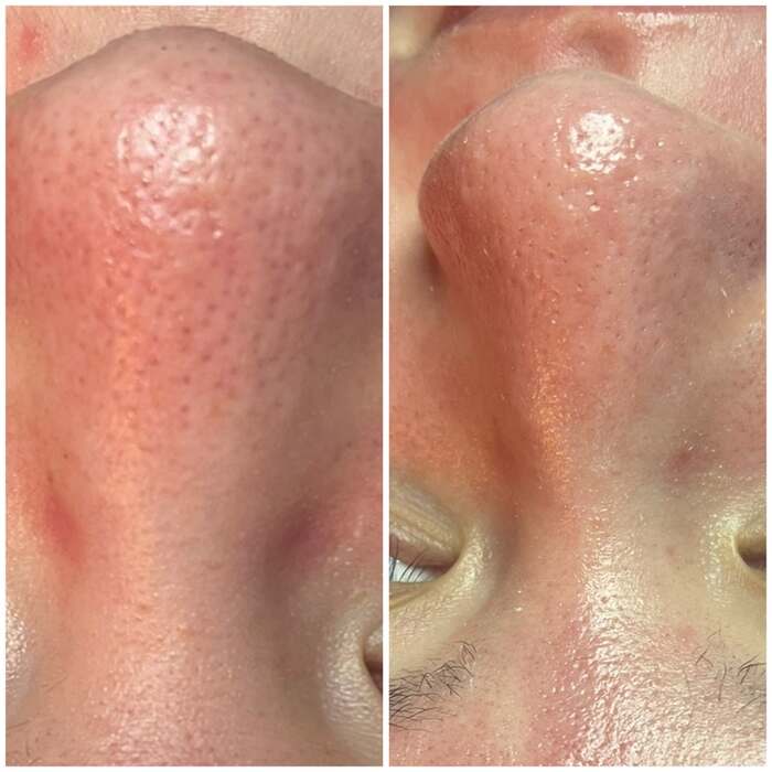 Before and after a course of treatment at Envy Skin Studio, example 12 of 16