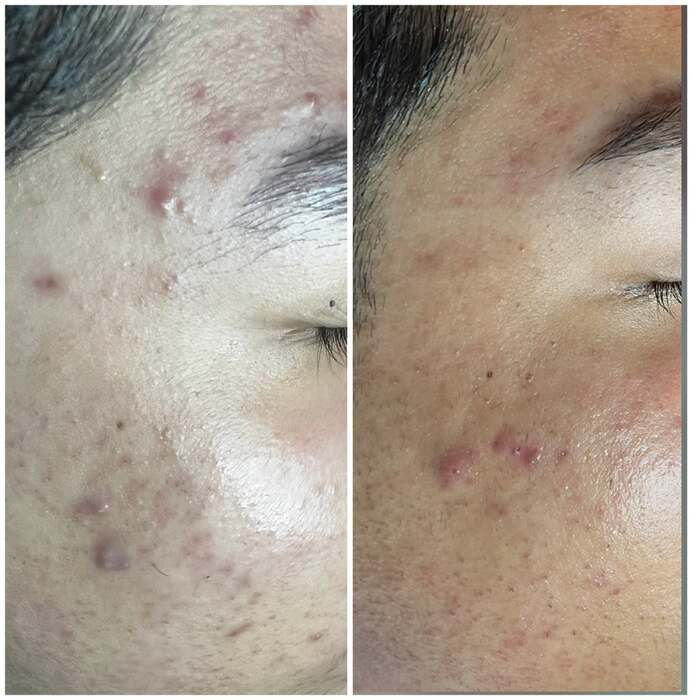 Before and after a course of treatment at Envy Skin Studio, example 14 of 16