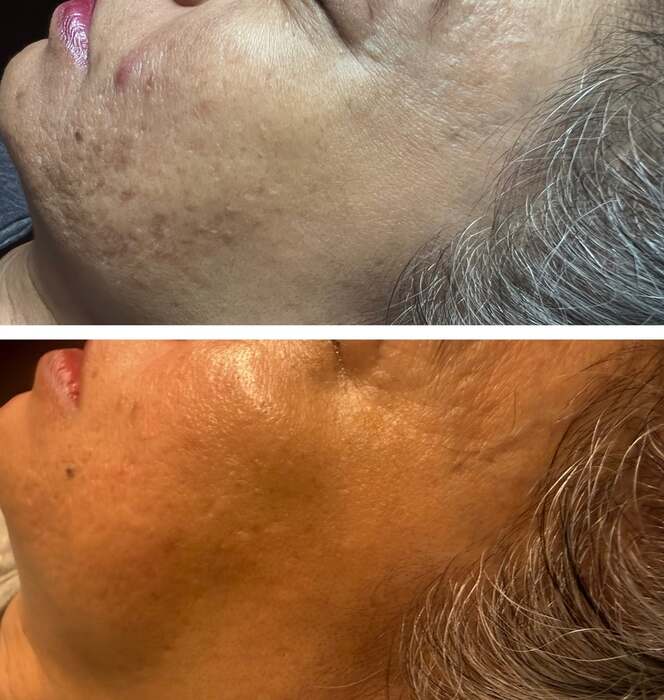 Before and after a course of treatment at Envy Skin Studio, example 16 of 16