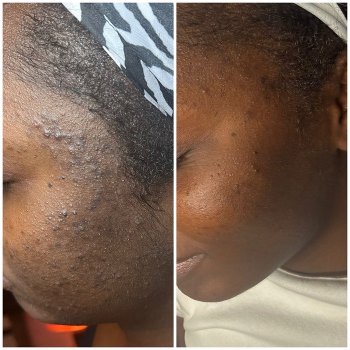 Before and after a course of treatment at Envy Skin Studio, example 2 of 16