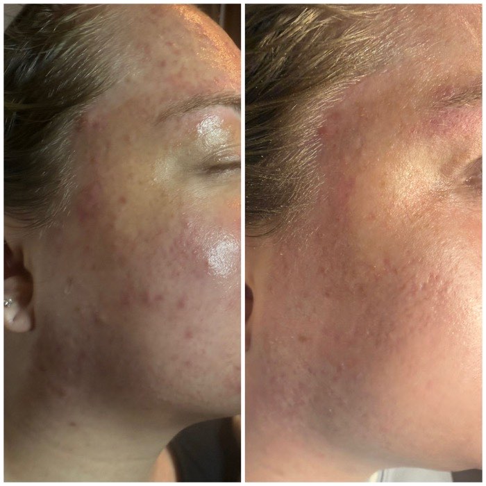 Before and after a course of treatment at Envy Skin Studio, example 3 of 16
