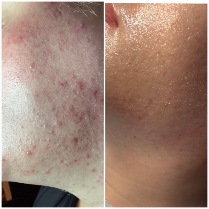 Before and after a course of treatment at Envy Skin Studio, example 4 of 16