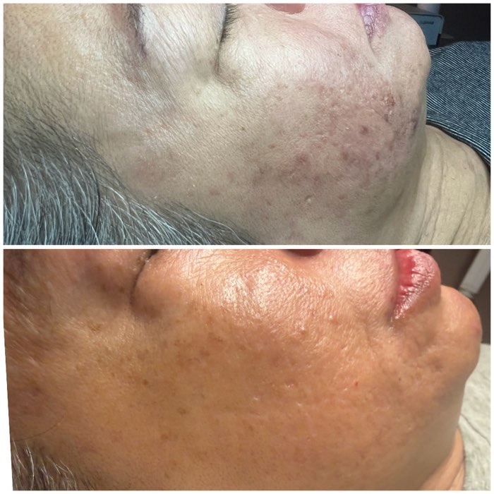 Before and after a course of treatment at Envy Skin Studio, example 5 of 16