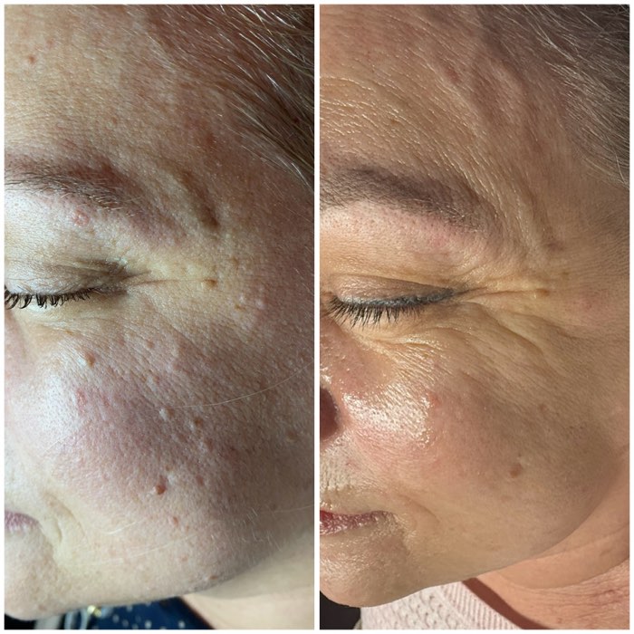 Before and after a course of treatment at Envy Skin Studio, example 6 of 16