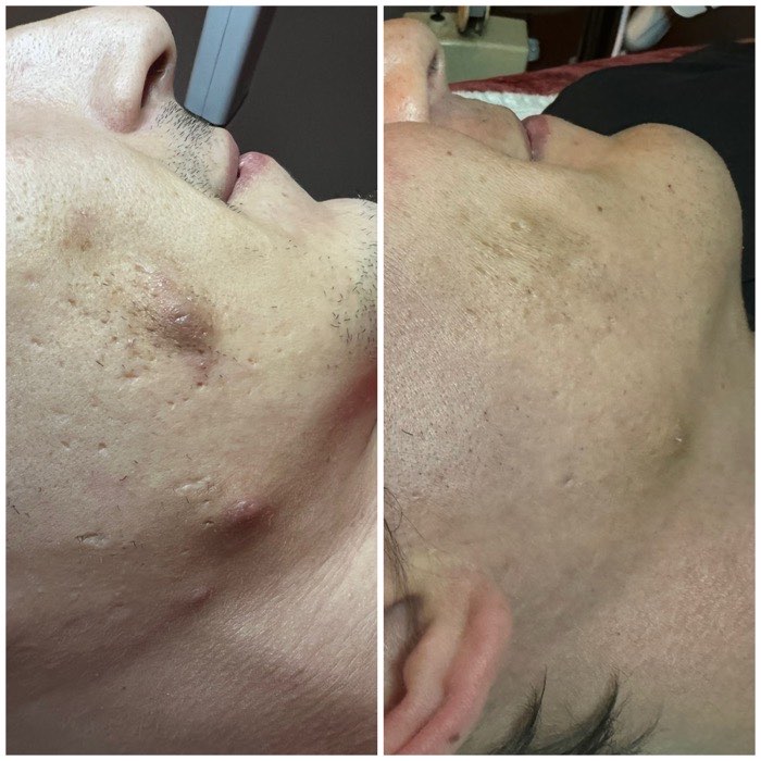Before and after a course of treatment at Envy Skin Studio, example 7 of 16