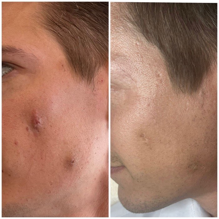 Before and after a course of treatment at Envy Skin Studio, example 8 of 16